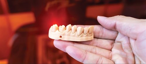 Fit to Print (Part 2) Interest in in-office aligner (IOA) systems is growing in the orthodontic community, yet a limited number of providers have implemented this system in their practices. In the second part of his series, Dr. Rooz Khosravi breaks down parts of an IOA system and provides readers with essential information on how they can build one at their practices.