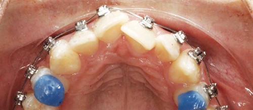 A Voice in the Arena: Bite Ramps, Part 1: Class 2 Bite Ramps Orthotown Editorial Director Dr. Chad Foster discusses how strategically positioning and shaping bite turbos has been a huge game-changer in clinical efficiency at his practice.