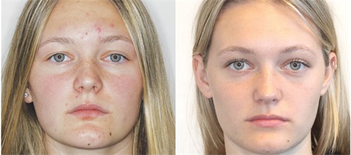 ‘Short-Face’ Patients—Part 2 In this second installment on treating “short-faced” patients, Dr. Chad Foster presents a case study highlighting aesthetic improvements achieved through bite turbos and elastic strategies to increase lower facial height. 