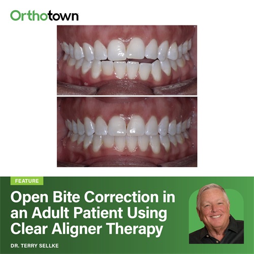 Open Bite Correction in an Adult Patient Using Clear Aligner Therapy Dr. Terry Sellke presents an eight-month case showing how advanced aligner materials and digital monitoring can deliver stable open-bite correction with minimal refinements.