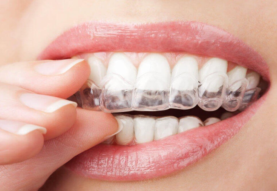 Is Invisalign Better Than Braces?