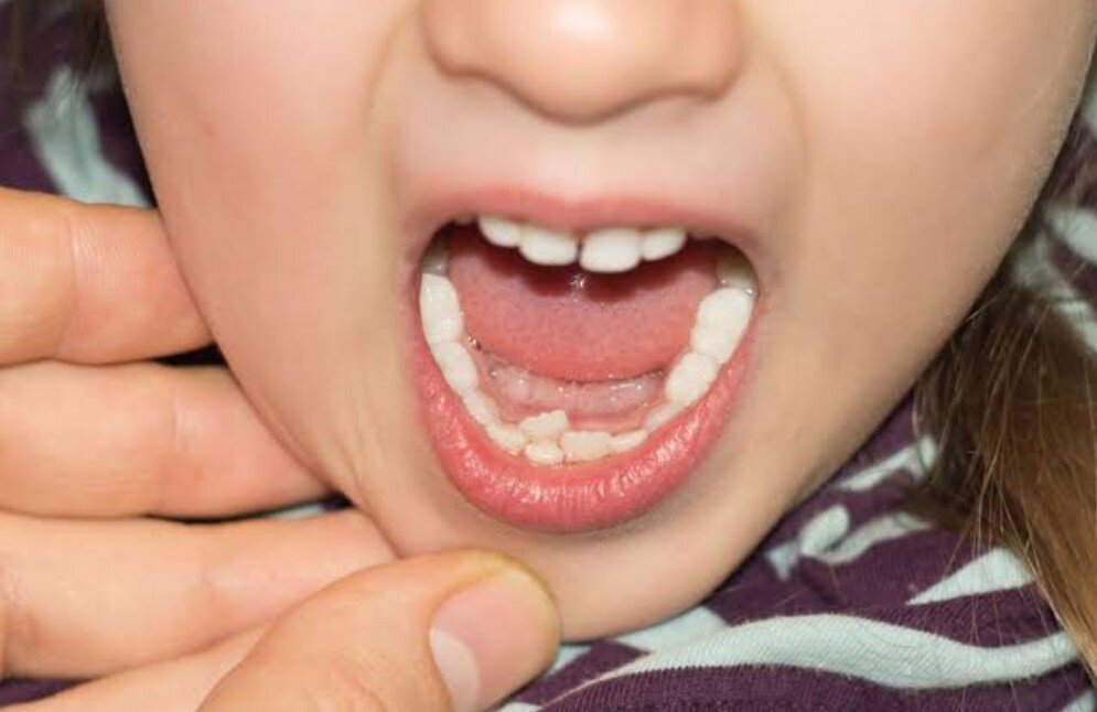 Shark Teeth in Kids: When Pediatric Dentists and Orthodontists Should Intervene