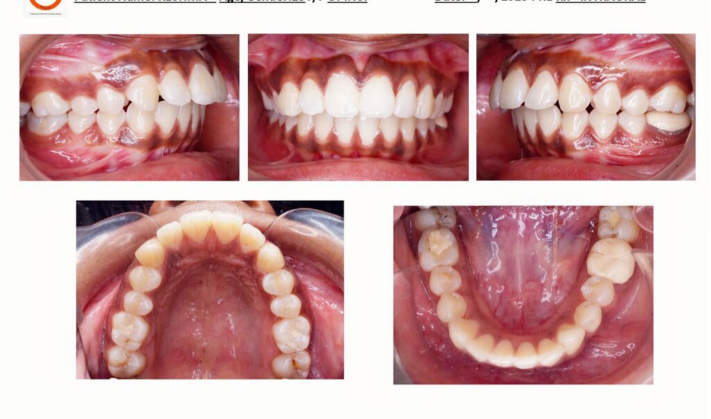 Managing Crowding with Clear Aligners: Where IPR Decisions Actually Get Made